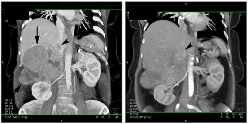 IVC thrombosis:Malignant thrombus